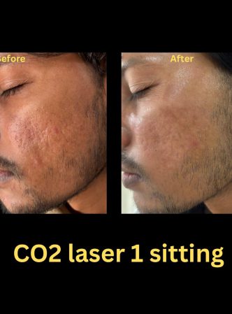 Co2 laser for acne scars